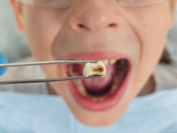 Best Emergency Dentist for Lost Fillings or Crowns in Collinsvle, IL
